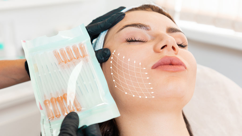 Illustration médicale des zones anatomiques du lifting cervico-facial sur profil féminin